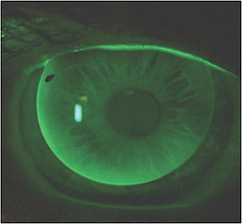 New Gas Permeable varifocal contact lenses
